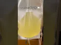 See What Cloudy Peritoneal Dialysis Effluent Looks Like
