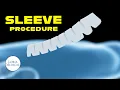 Loria Medical SLEEVE procedure how it s done Update 2025