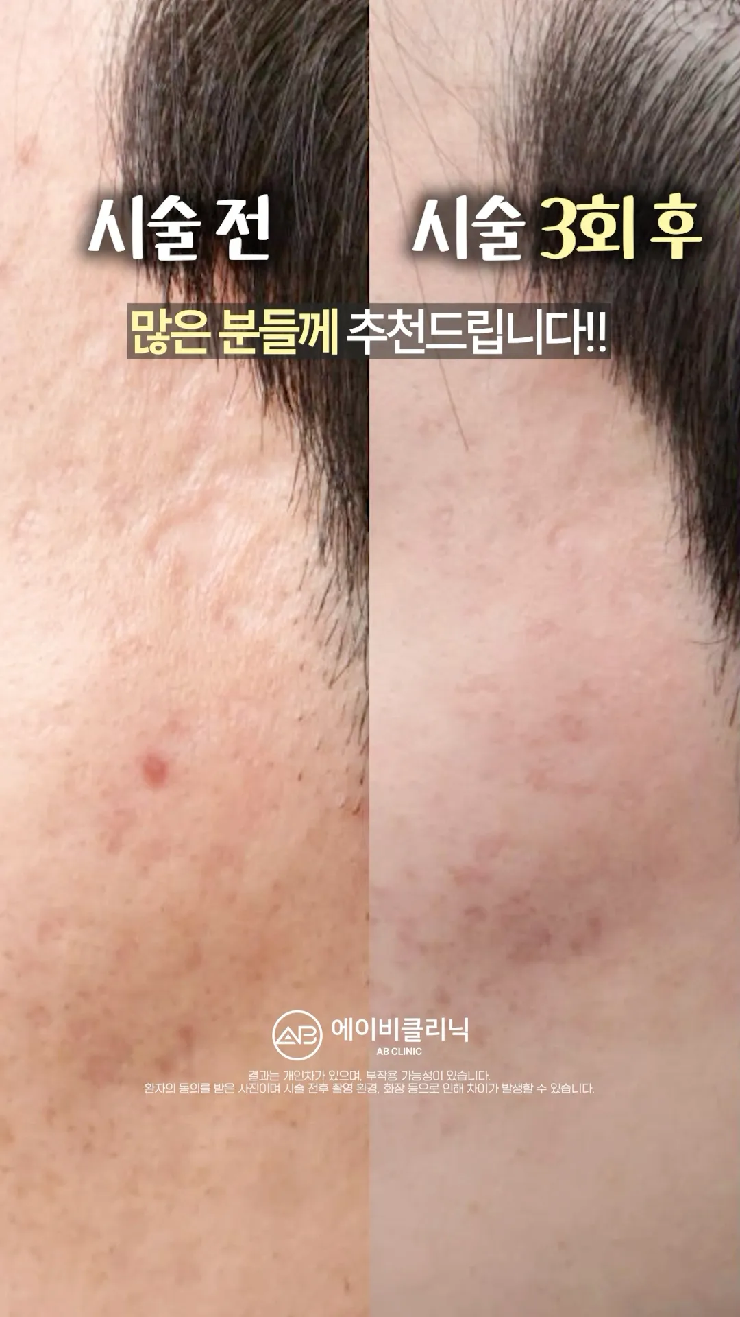 여드름 흉터 이 3가지만 기억하세요☑️