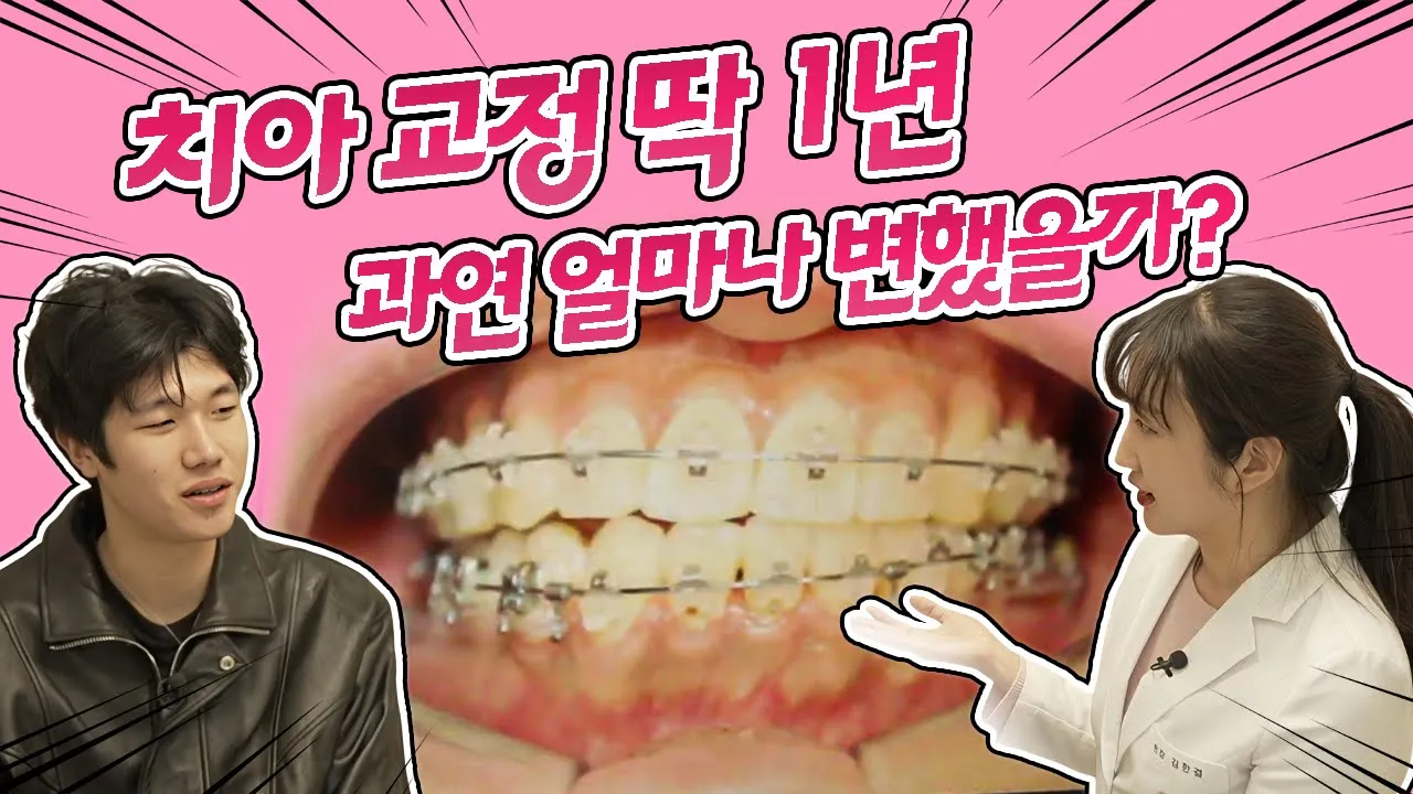 딱 1년 치아 교정 과정 결과! 처음과 1년 후, 얼마나 달라졌을까? #치아교정 #교정치료과정 #교정과정 I 스마일뷰치과 러블리 김원장