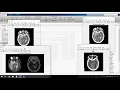 A Fast Fractal Based Compression for MRI Images in Matlab