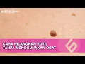 Download Lagu Ampuh! Cara Hilangkan Kutil Dengan Bawang Putih Agar Tak Tumbuh Lagi