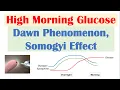 High Early Morning Glucose Dawn Phenomenon Somogyi Effect