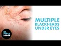 Multiple Blackheads Under the Eyes Safely Removed by Dr Pimple Popper