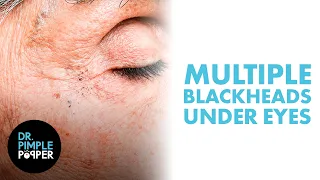 Multiple Blackheads Under the Eyes Safely Removed by Dr Pimple Popper