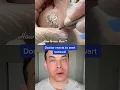 Download Lagu HUGE plantar wart removal! | 208SkinDoc