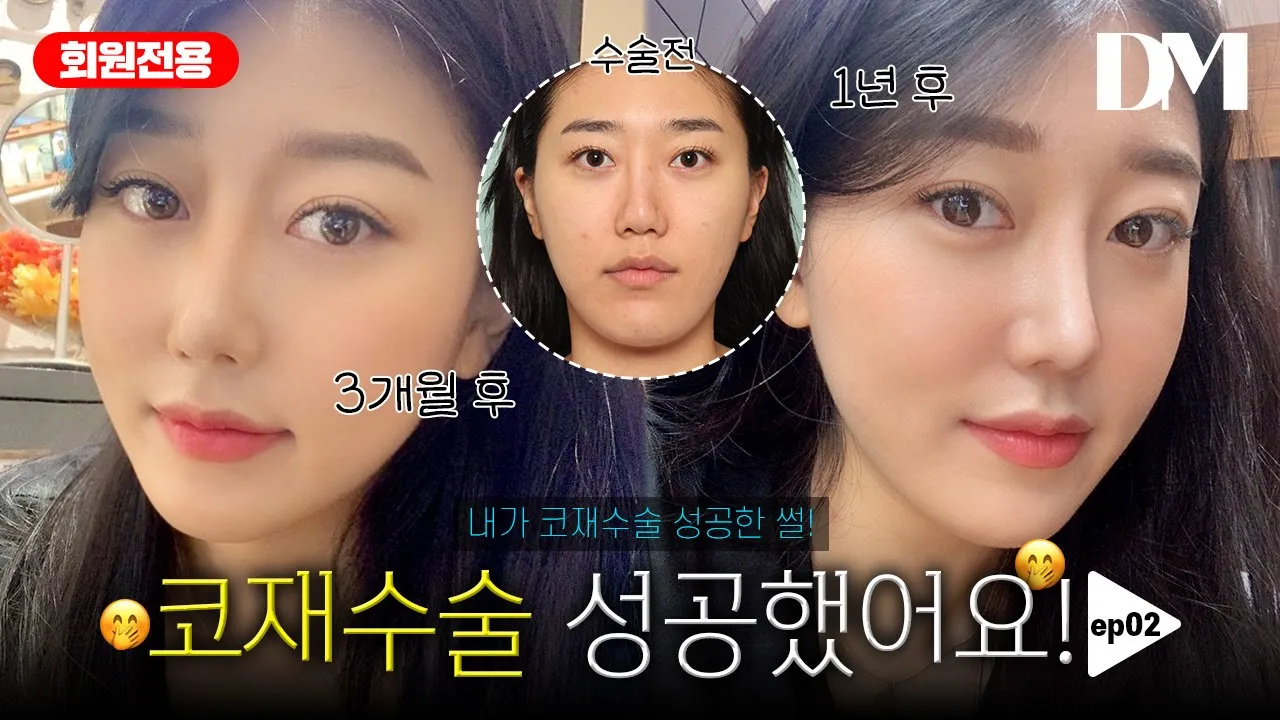 코 재수술 리얼 후기 2탄 보기만 해도 스트레스 받았던 내코 명품코 되다 ㅣ압구정 디엠성형외과