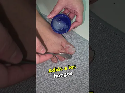 Para eliminar los hongos en las uñas