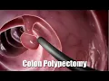 Removing a polyp from the colon 3D Animation