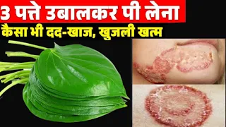 दाद खाज खुजली की 2 दिन में छुट्टी कर देगा Fungal Infection Treatment at Home / Daad Khaj Khujli