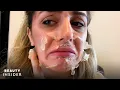 What It s Like To Get A Chemical Peel For Acne Scars Beauty Explorers Beauty Insider