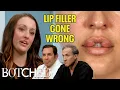 Keara Hasn t Closed Her Mouth in 10 Years After Bad Lip Injections Before After Botched E