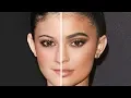KYLIE JENNER Before and After Plastic Surgery