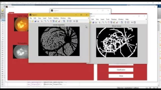 Retinal Disease Screening through Local Binary Patterns matlab projects