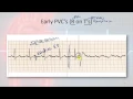 Basic Electrophysiology part 9 - Ventricular Rhythms