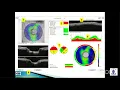Dr Muralidhar - OCT in Glaucoma