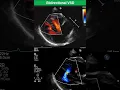 Download Lagu Communication interventriculaire bidirectionnelle - Stade précoce du syndrome d'Eisenmenger