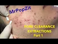 Inflammatory acne extracted See the meticulous procedure close up and his path to clearance