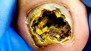 Half Of My Toenails Are Moldy, Trim Them Step By Step!【Xue Yidao】