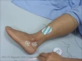 Sural Sensory
