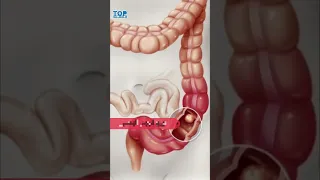 ما هي اضرار الرمان على المعدة  ما هي اضرار الرمان على المعدة