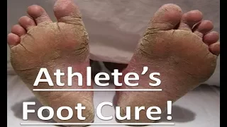 Download Tea Tree Oil - All Natural Athlete's Foot Home Remedy MP3