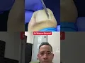 Download Lagu COLOSSAL INGROWN TOENAIL 🍔 #shorts #ingrowntoenail