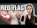 Bruising Easily Here Are the Red Flags