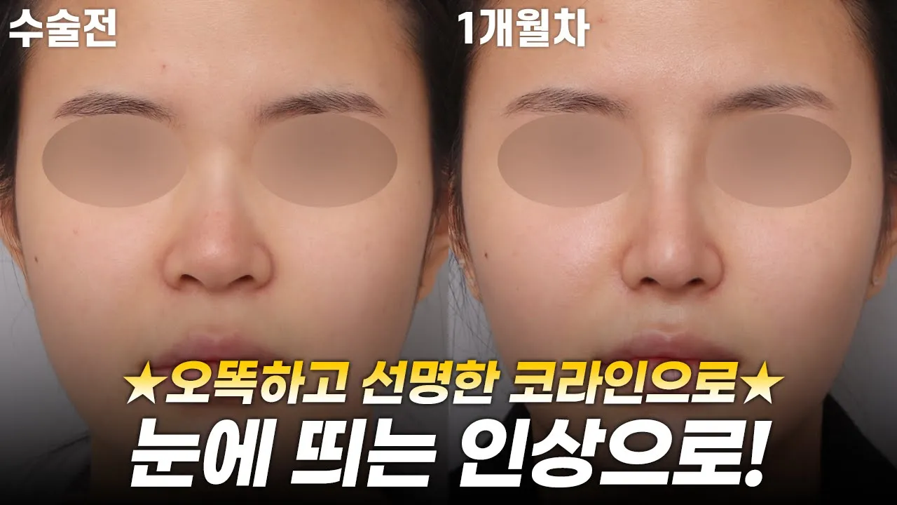 뒤밑트임으로 확 선해진 인상! 이쁘다 이뻐🤗 #눈매교정 #코성형 #뒤밑트임