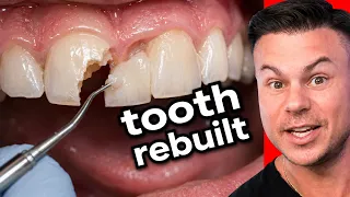They Rebuilt This Tooth From Nothing..