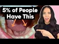 Do You Have These In Your Mouth Mandibular Tori Explained