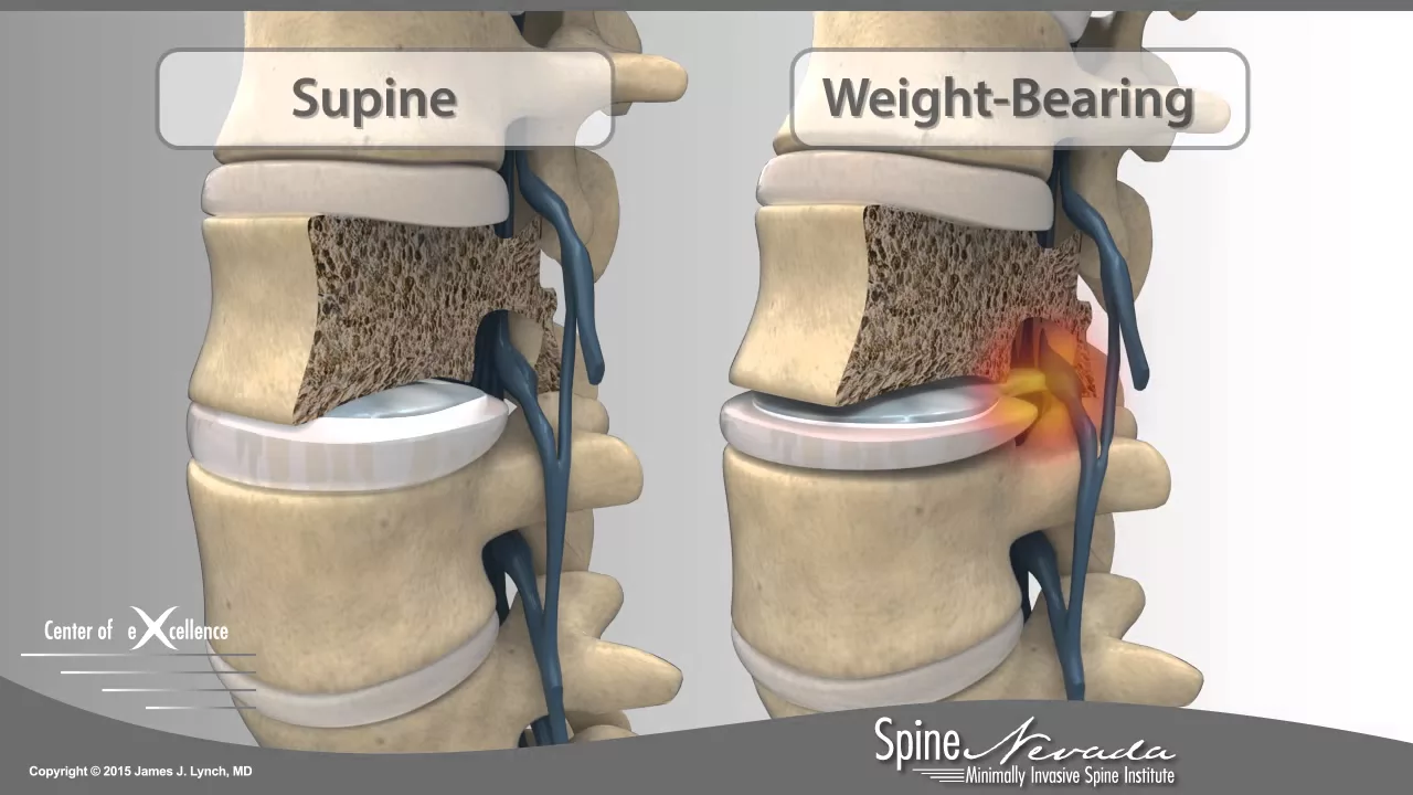 Acute Low Back Pain , Lumbar Disc Herniation - Everything You Need To Know - Dr. Nabil Ebraheim. 