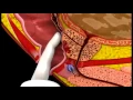 Download Lagu Prostate Cancer - 3D Medical Animation || ABP ©