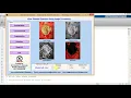 Ulcer Disease Detection using Image Processing Matlab Project