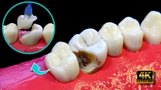 Is it possible to save a tooth broken due to decay?