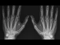 RFID implant pt 2 answering commonly asked questions