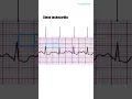 Download Lagu Basics of ECG: Sinus Tachycardia