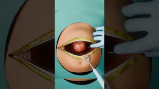 اغرب شئ في الولادة القيصرية دكتور طبيب ترند اسعافات اولية مصر 