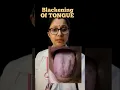 Download Lagu जीभ पर काले धब्बे🔴ALERT|| Blackening Of Tongue