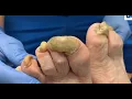 Download Lagu Extreme Toenail Trimming – Satisfying Nail Cleaning Transformation