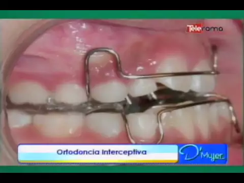 Ortodoncia interceptiva