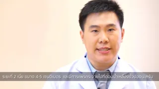 มะเร็งปอดมีอาการอย่างไรในระยะเริ่มต้น และทำไมจึงถือว่าเป็น "ภัยร้ายซ่อนเงียบ"?