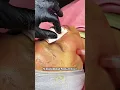 Download Lagu TREATMENT DERMAPEN / SPA KUANTAN / TREAMENT JERAWAT /TREAMEMENT JERAGAT