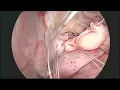 Download Lagu MINIMALLY INVASIVE MITRAL VALVE REPAIR(MICS  MV REPAIR)