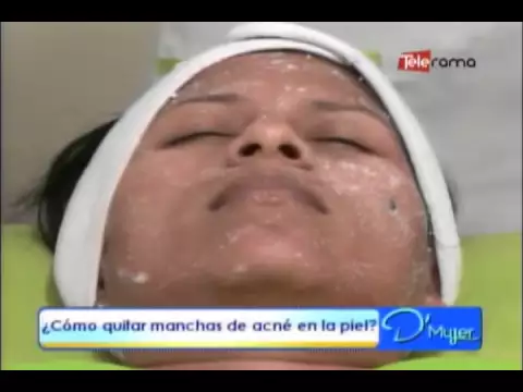 ¿Cómo quitar manchas de acné en la piel?