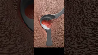 Why Do I Need Fistula Surgery Shorts Fistula 