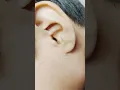 Download Lagu How to put Ear drops #shorts #short #shortsfeed
