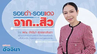 รอยแดงและรอยดำที่เกิดจากสิวมีความแตกต่างกันอย่างไรในแง่ของการรักษา