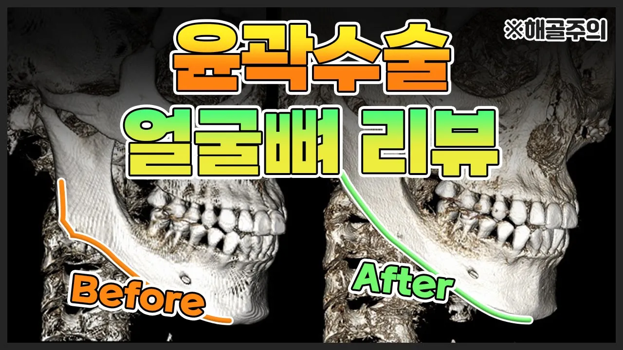 [안면윤곽] 여기가 돌려깎기 맛집인가요?? 네 맞습니다! 윤곽수술 전후 보고 가세요~  CT로 확인하는 사각턱, 광대 수술 후 경과!  (※💀주의)