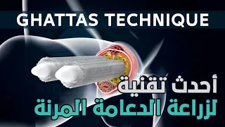 أحدث تقنية لزراعة الدعامة المرنة Ghattas Technique 